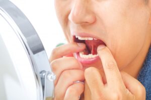 男性が鏡を見ながら自分の口の中の状態を確認をしている様子の写真