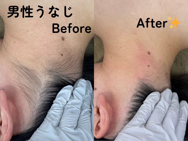 男性の襟足、うなじ部分のワックス脱毛前と後の比較画像